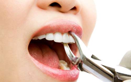 Удаление и лечение зубов
