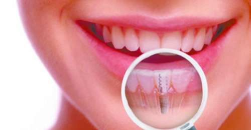 Протезирование зубов по доступным ценам
